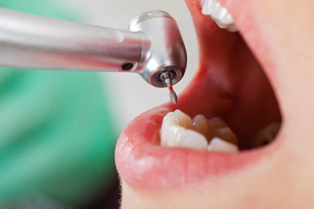 Best Emergency Root Canal Treatment in Mclean, VA